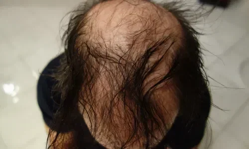 Finally Hair fibers for men before and after results